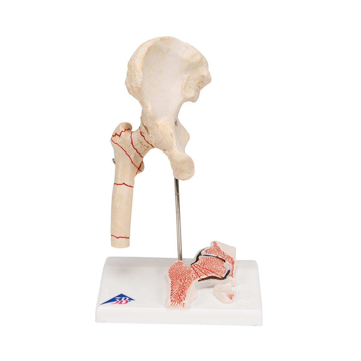 Femoral Fracture and Hip Osteoarthritis Model
