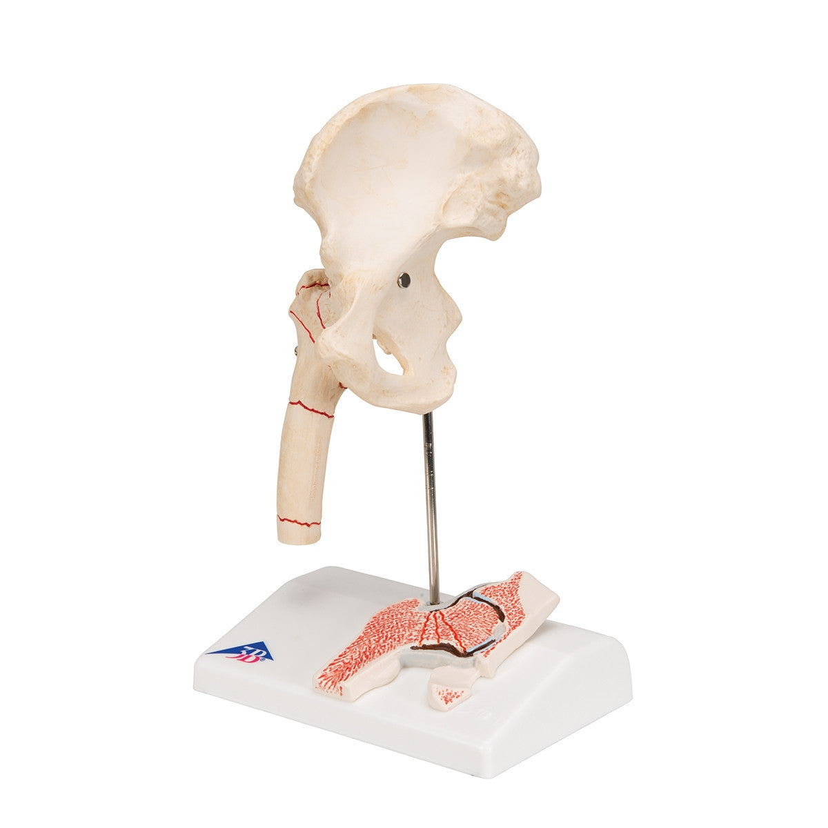 Femoral Fracture and Hip Osteoarthritis Model