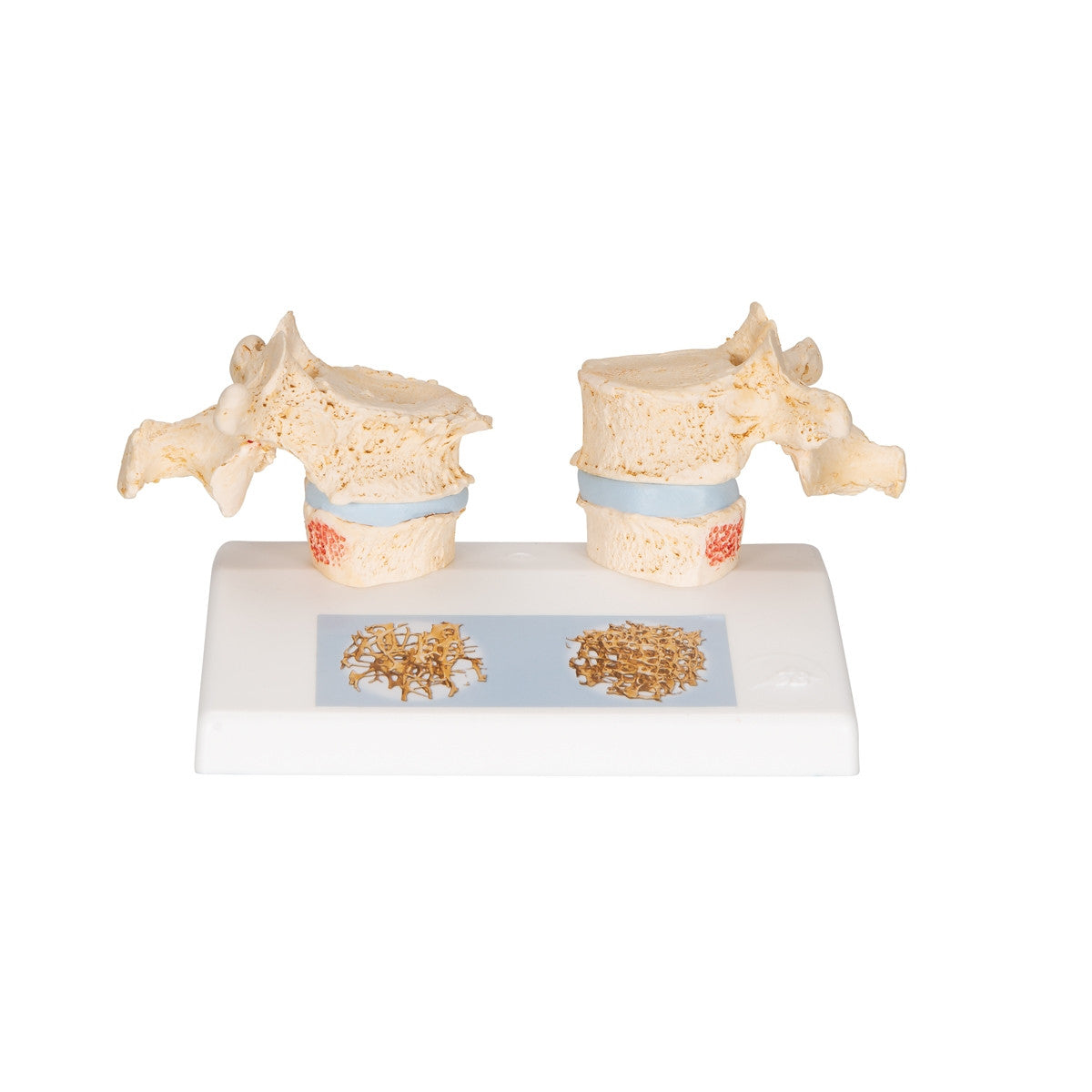 Osteoporosis of the Thoracic Spine Model