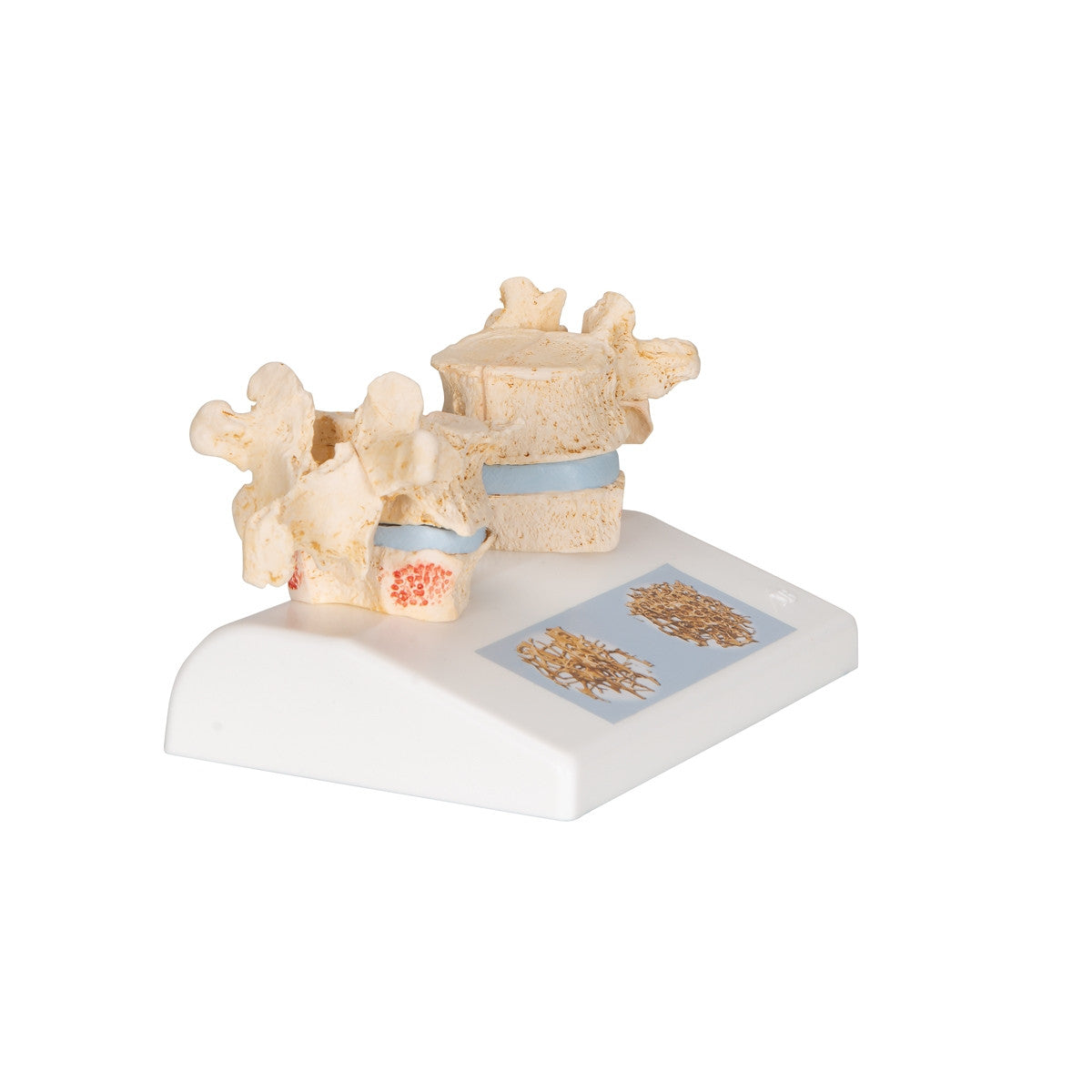 Osteoporosis of the Thoracic Spine Model