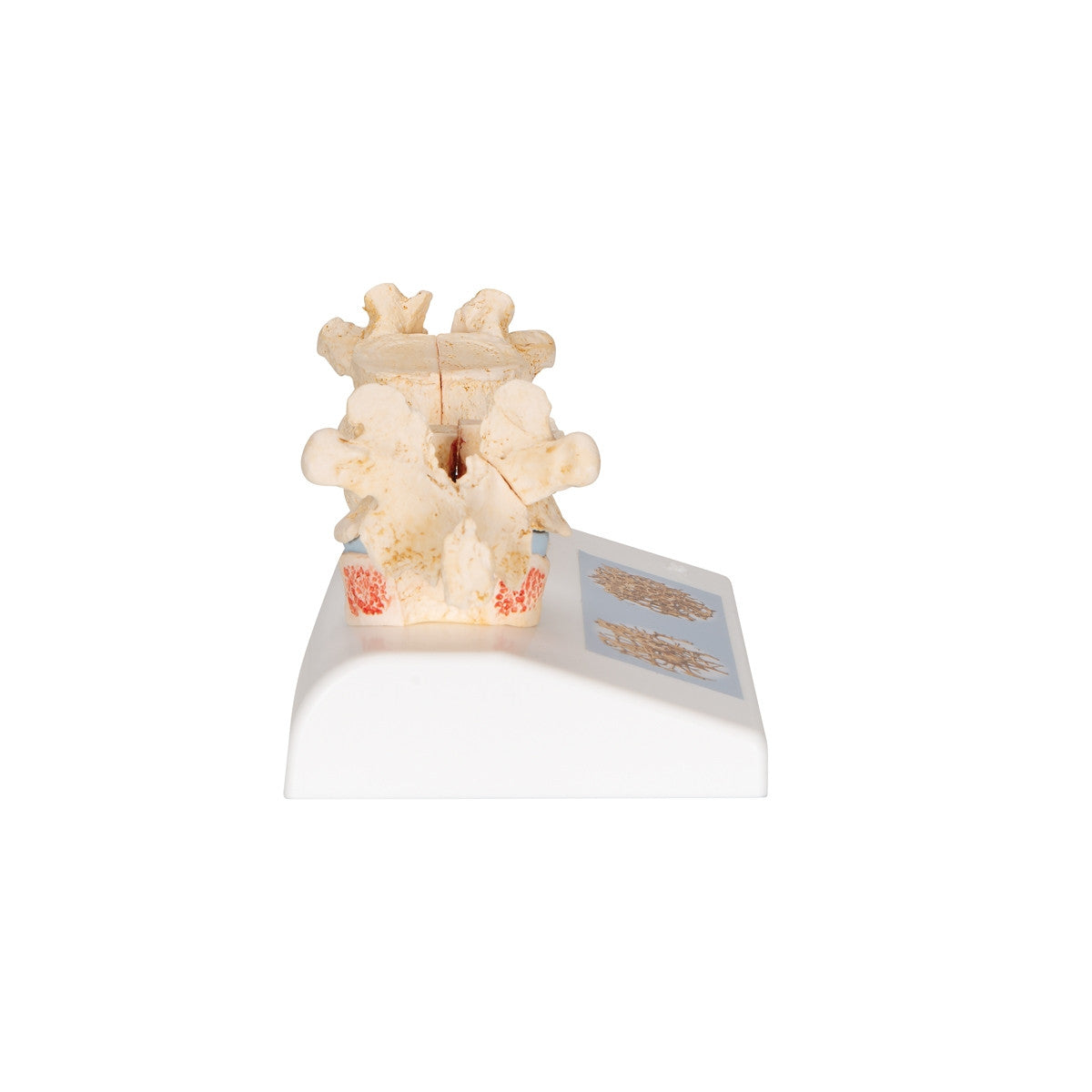 Osteoporosis of the Thoracic Spine Model