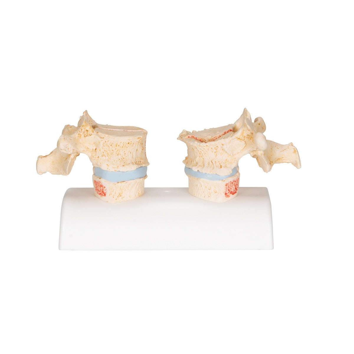 Osteoporosis of the Thoracic Spine Model