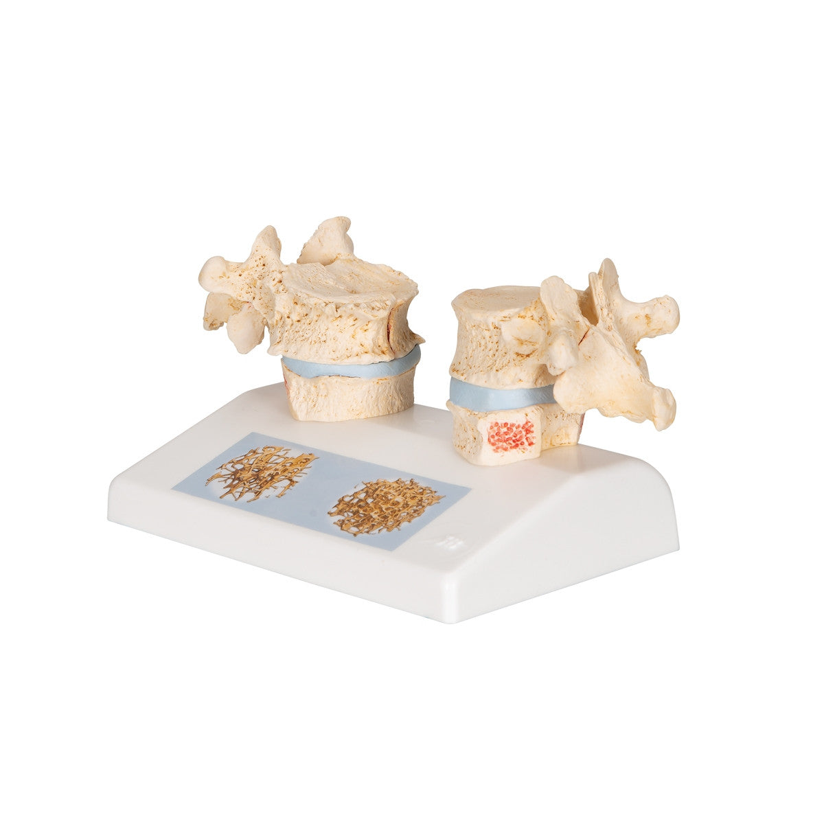 Osteoporosis of the Thoracic Spine Model