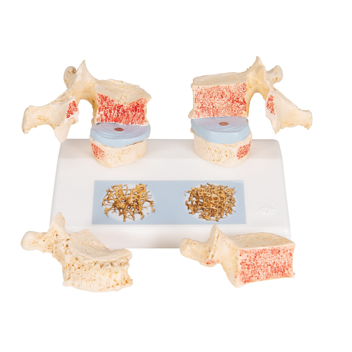 Osteoporosis of the Thoracic Spine Model