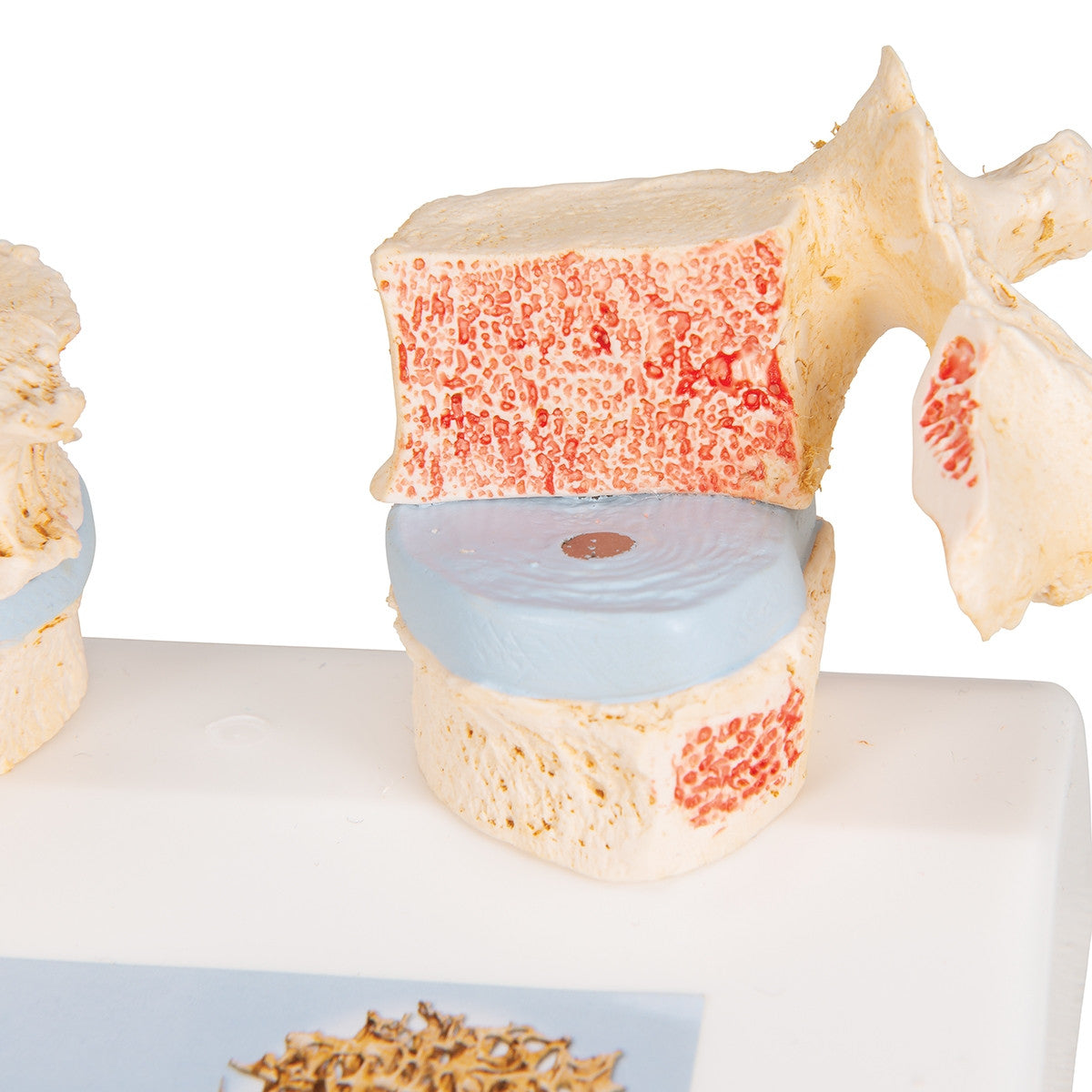 Osteoporosis of the Thoracic Spine Model