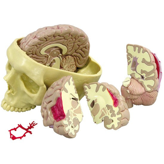 Diseased Brain in Skull Model