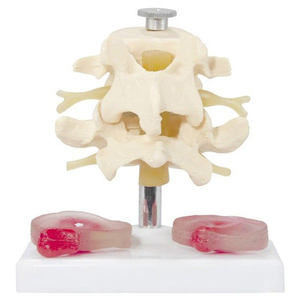 Lumbar Vertebra Model with Interchangeable Discs (6 part)