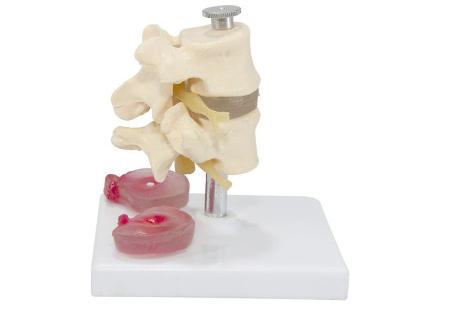 Lumbar Vertebra Model with Interchangeable Discs (6 part)