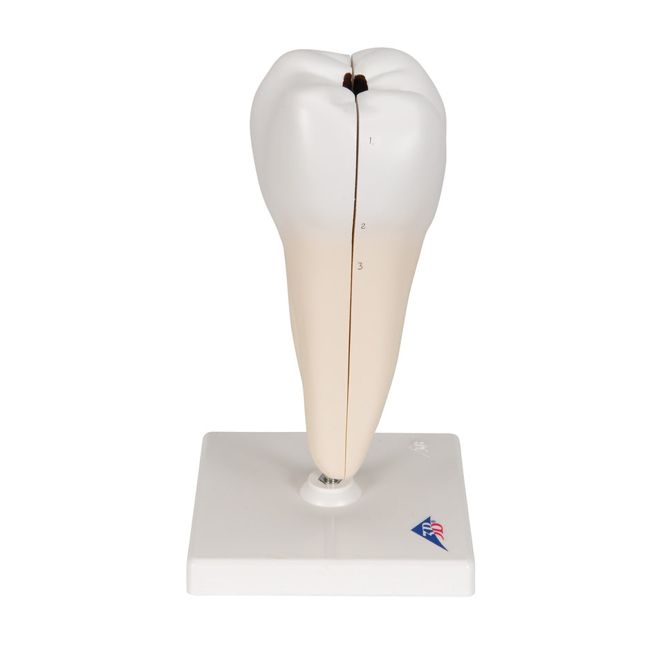 Lower Twin-Root Molar Model showing Cavities (2 part)