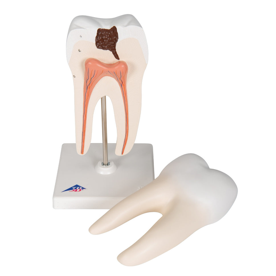 Lower Twin-Root Molar Model showing Cavities (2 part)