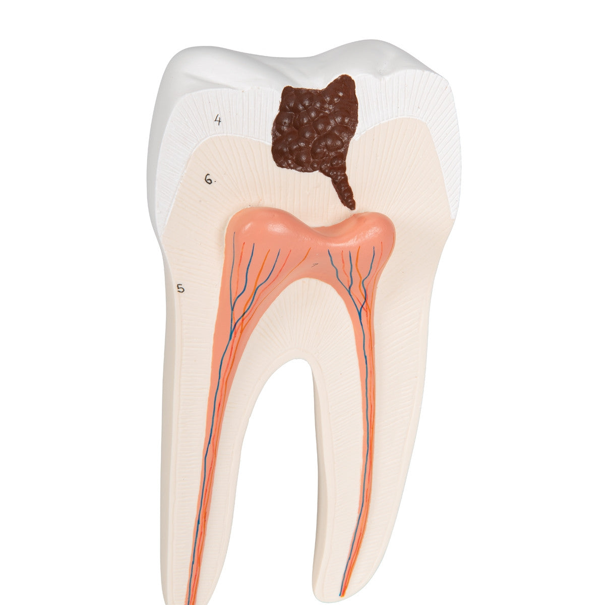 Lower Twin-Root Molar Model showing Cavities (2 part)