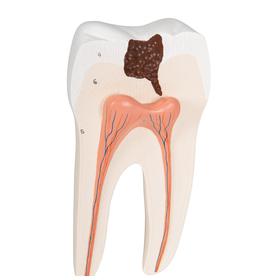 Lower Twin-Root Molar Model showing Cavities (2 part)