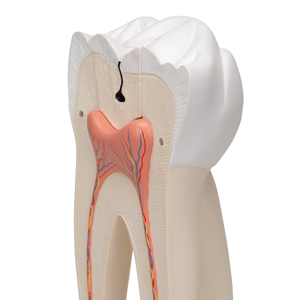 Giant Molar Model with Dental Cavities (15 times life size, 5 part)