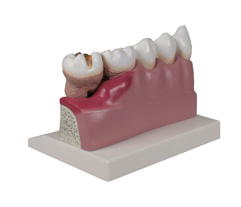 Tooth Disease Model (4 times life size)