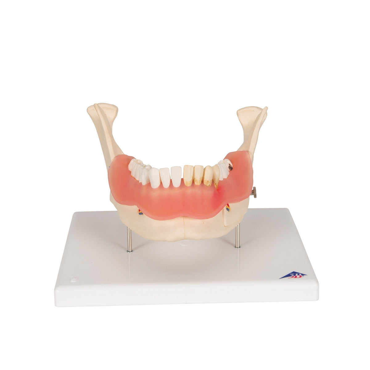 Dental Disease Model (2 times life size, 21 parts)