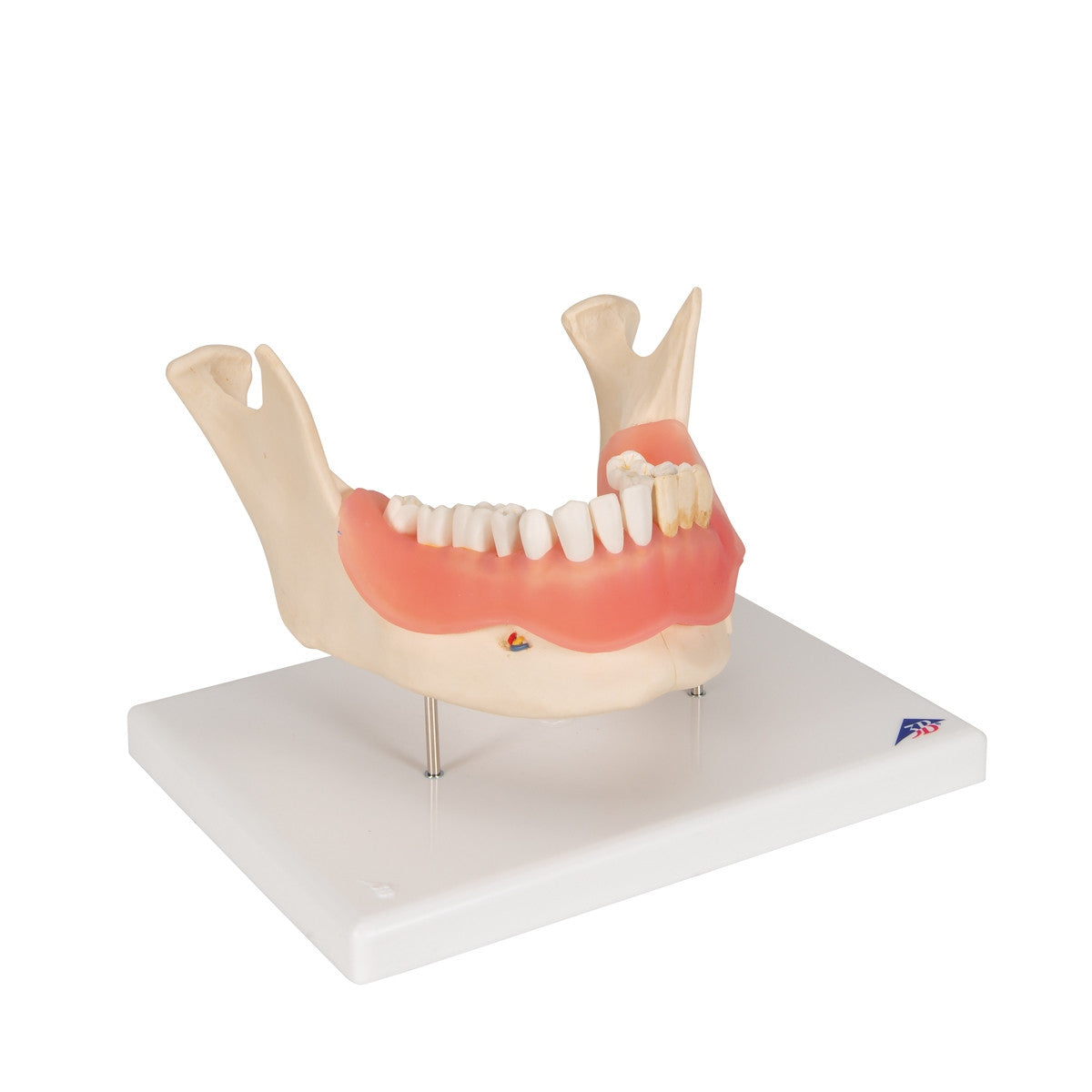 Dental Disease Model (2 times life size, 21 parts)