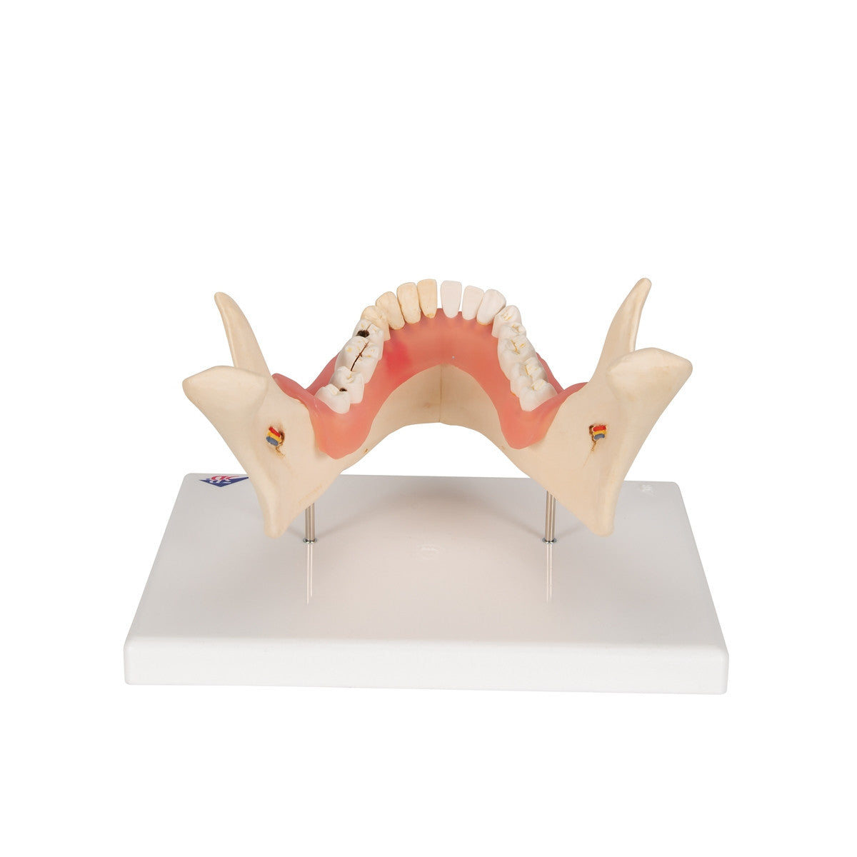 Dental Disease Model (2 times life size, 21 parts)