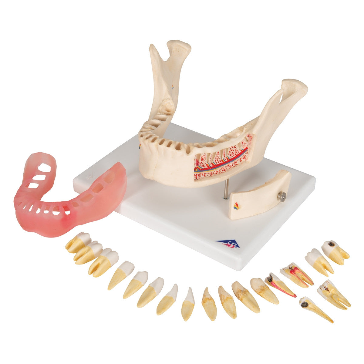 Dental Disease Model (2 times life size, 21 parts)