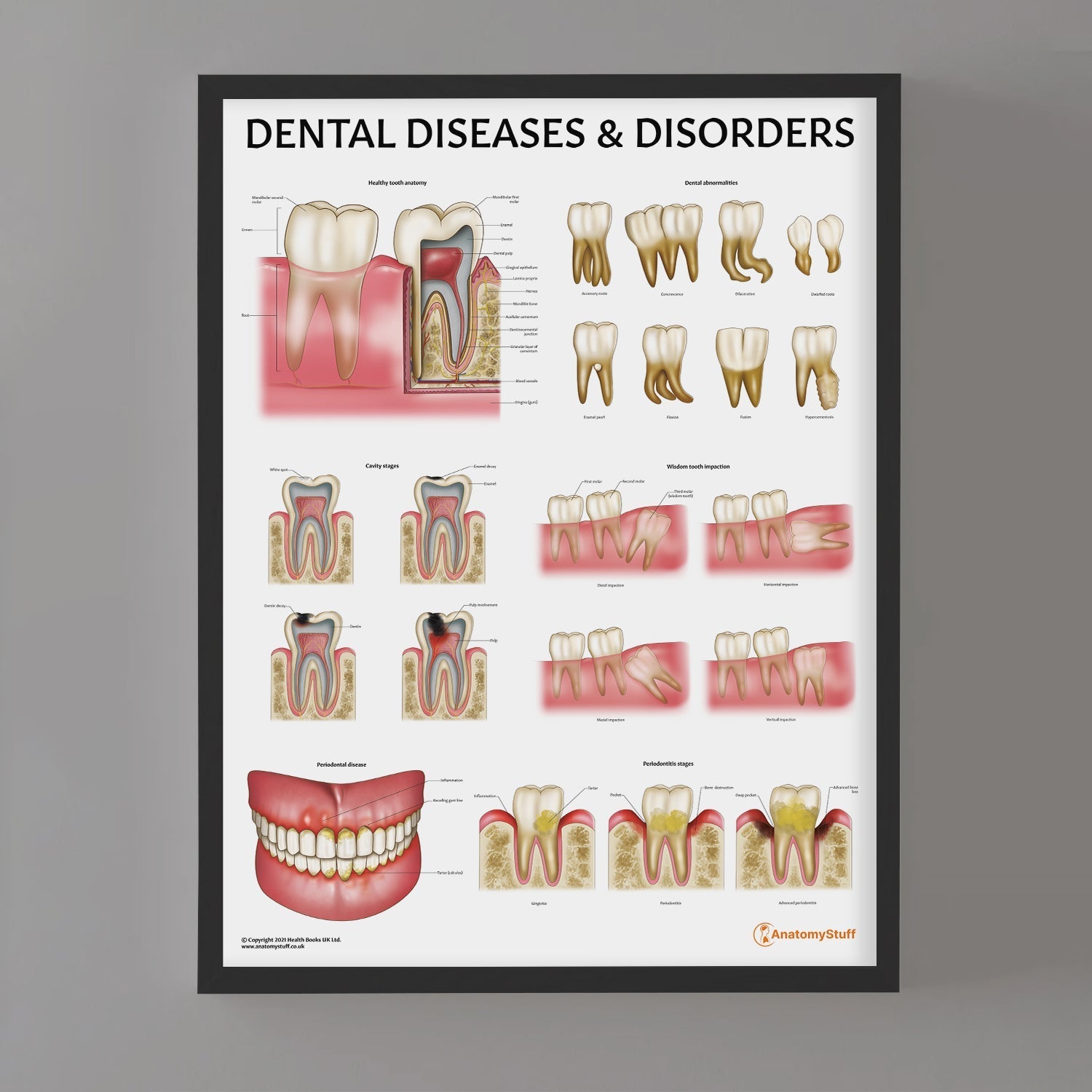 Dental Diseases & Disorders Chart / Poster - Part of Collection