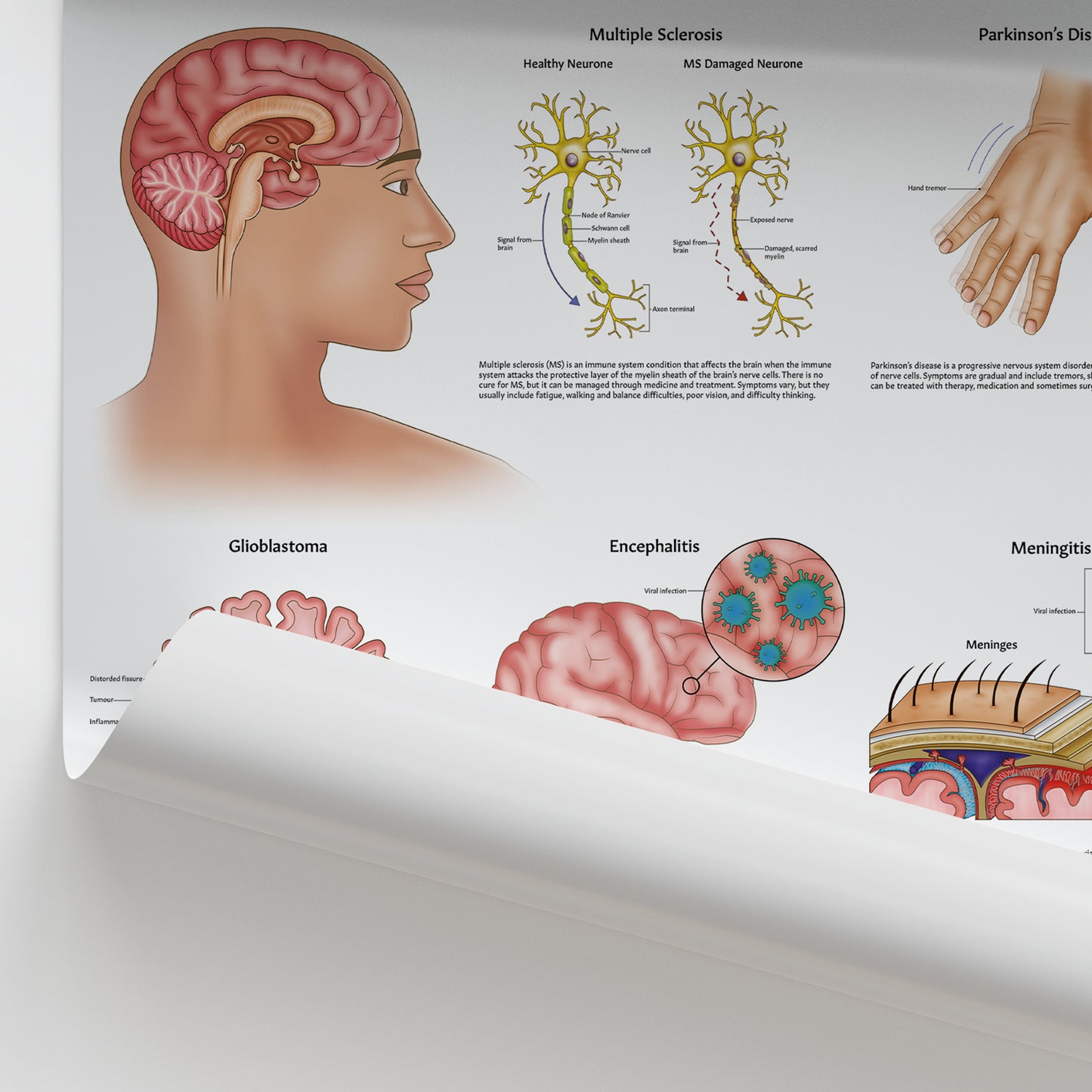Diseases & Disorders of the Brain Chart / Poster