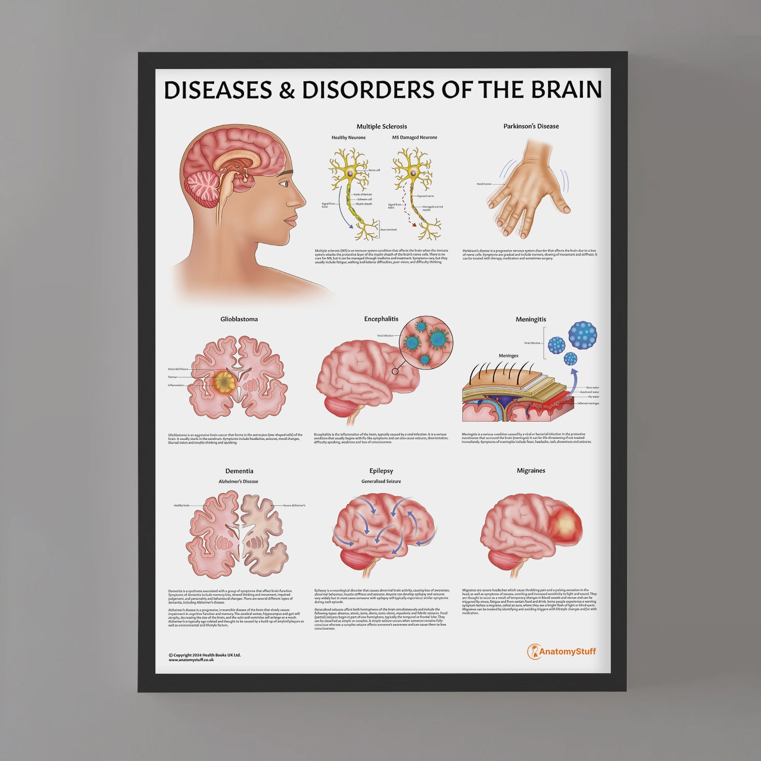 Diseases & Disorders of the Brain Chart / Poster