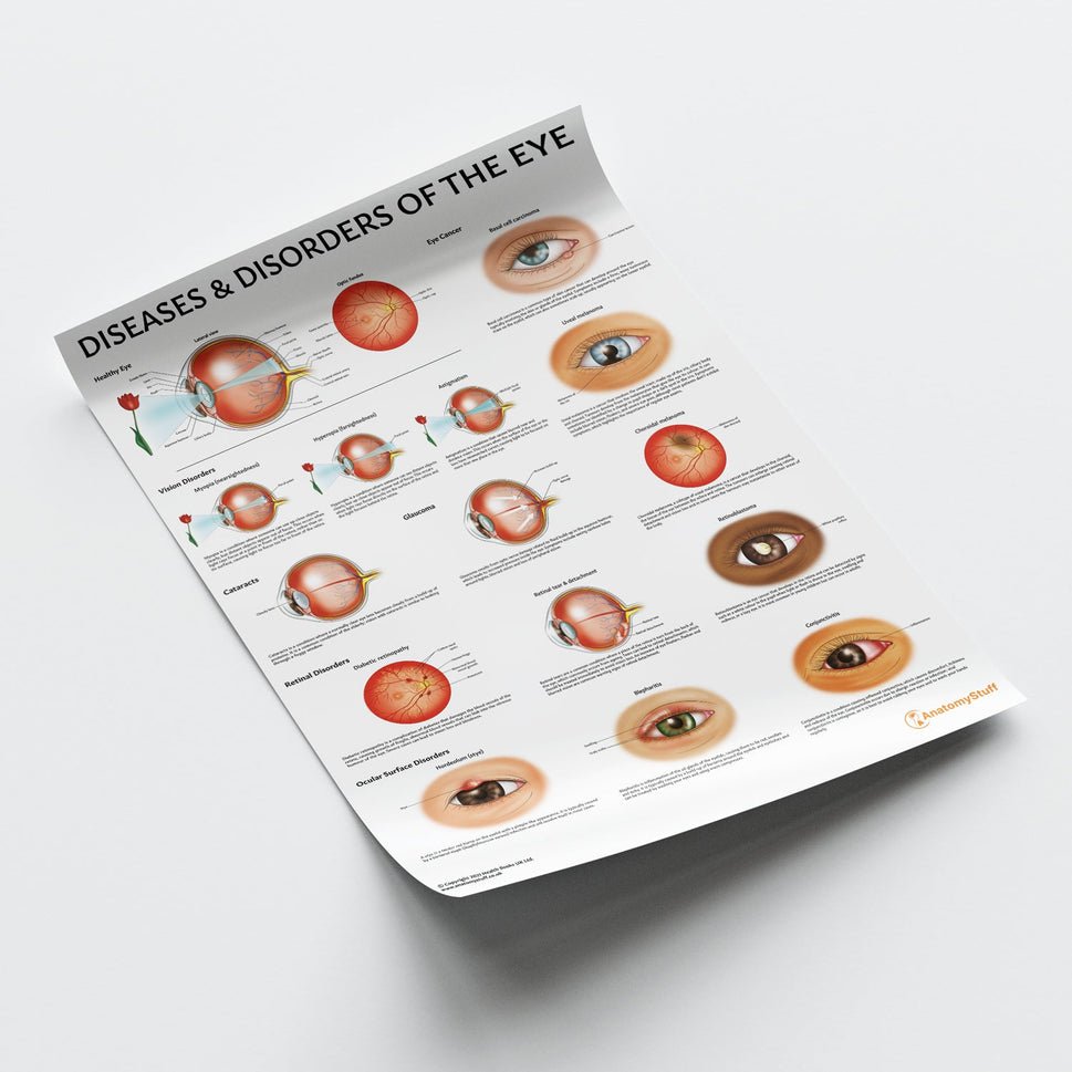 Diseases and Disorders of the Eye Chart / Poster