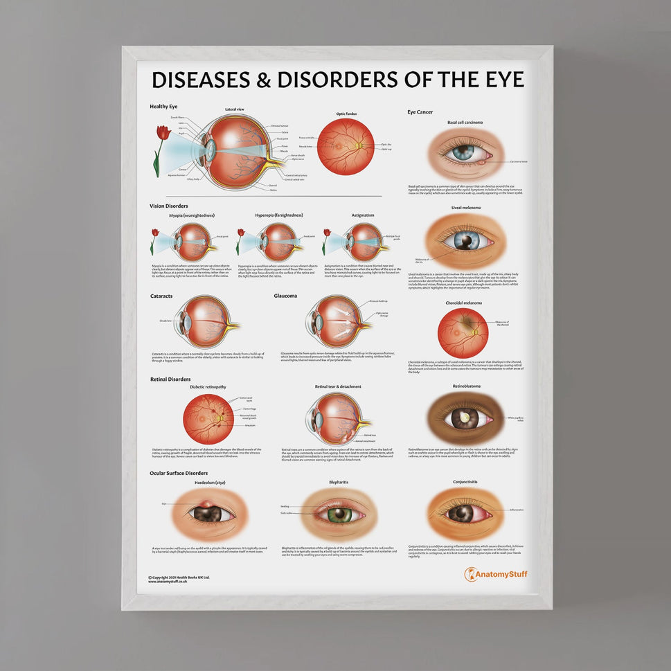 Diseases and Disorders of the Eye Chart / Poster