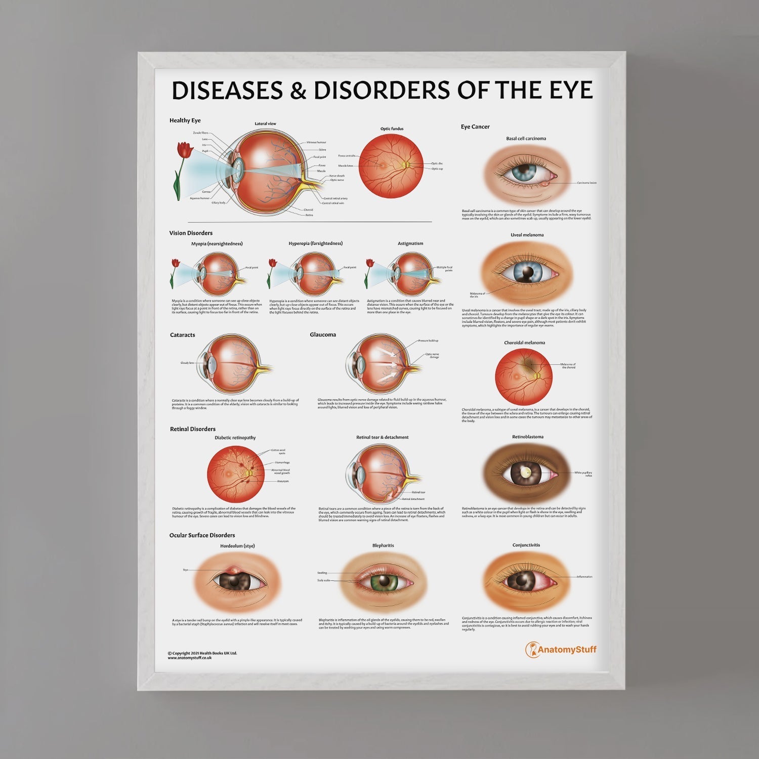 Diseases and Disorders of the Eye Chart / Poster - Part of Collection