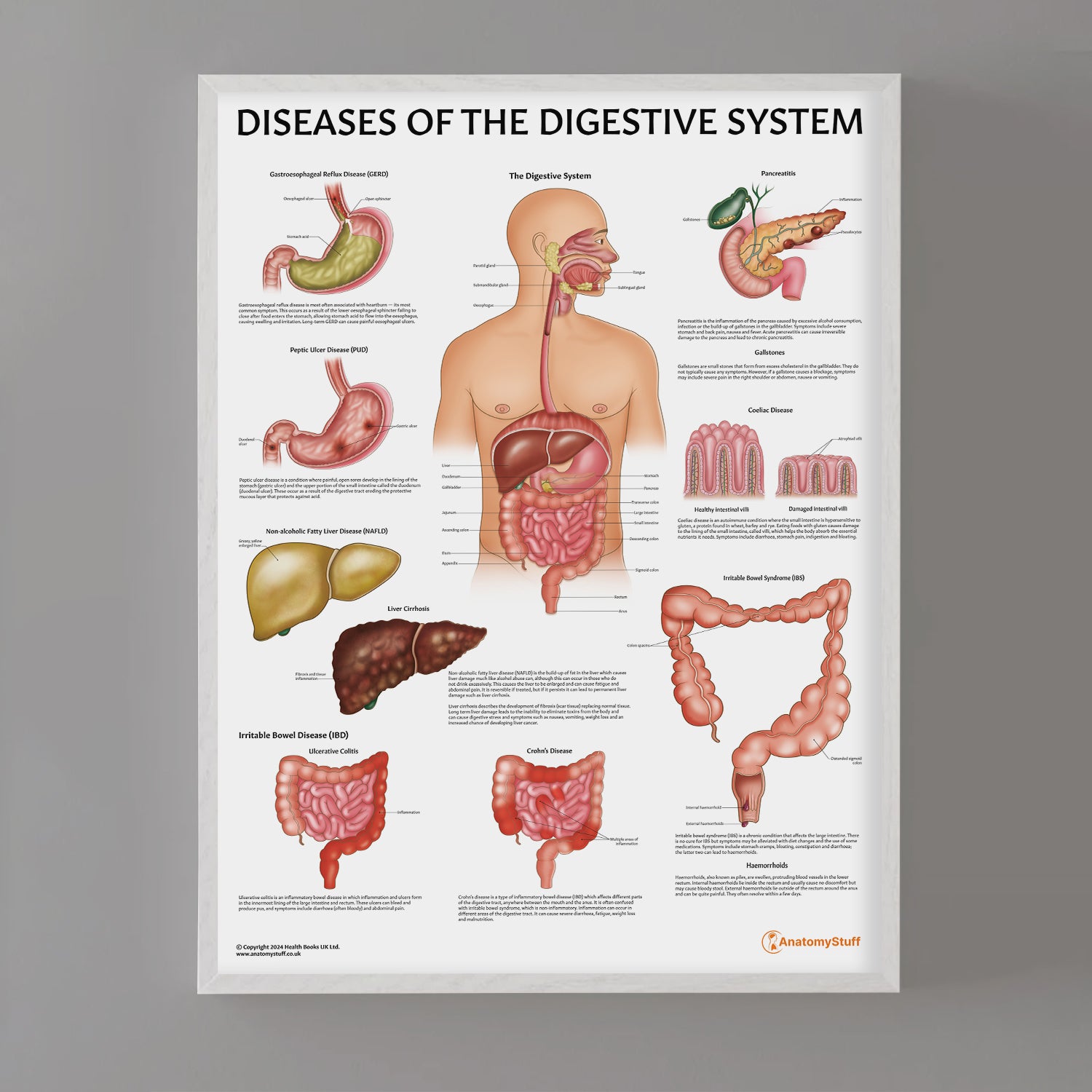 Diseases of the Digestive System Chart / Poster
