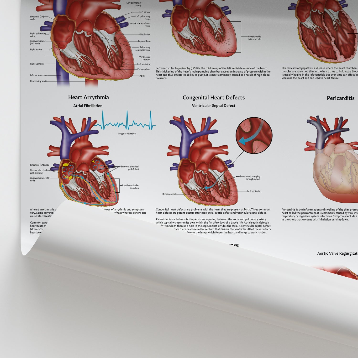 Diseases of the Heart Chart / Poster - Part of Collection