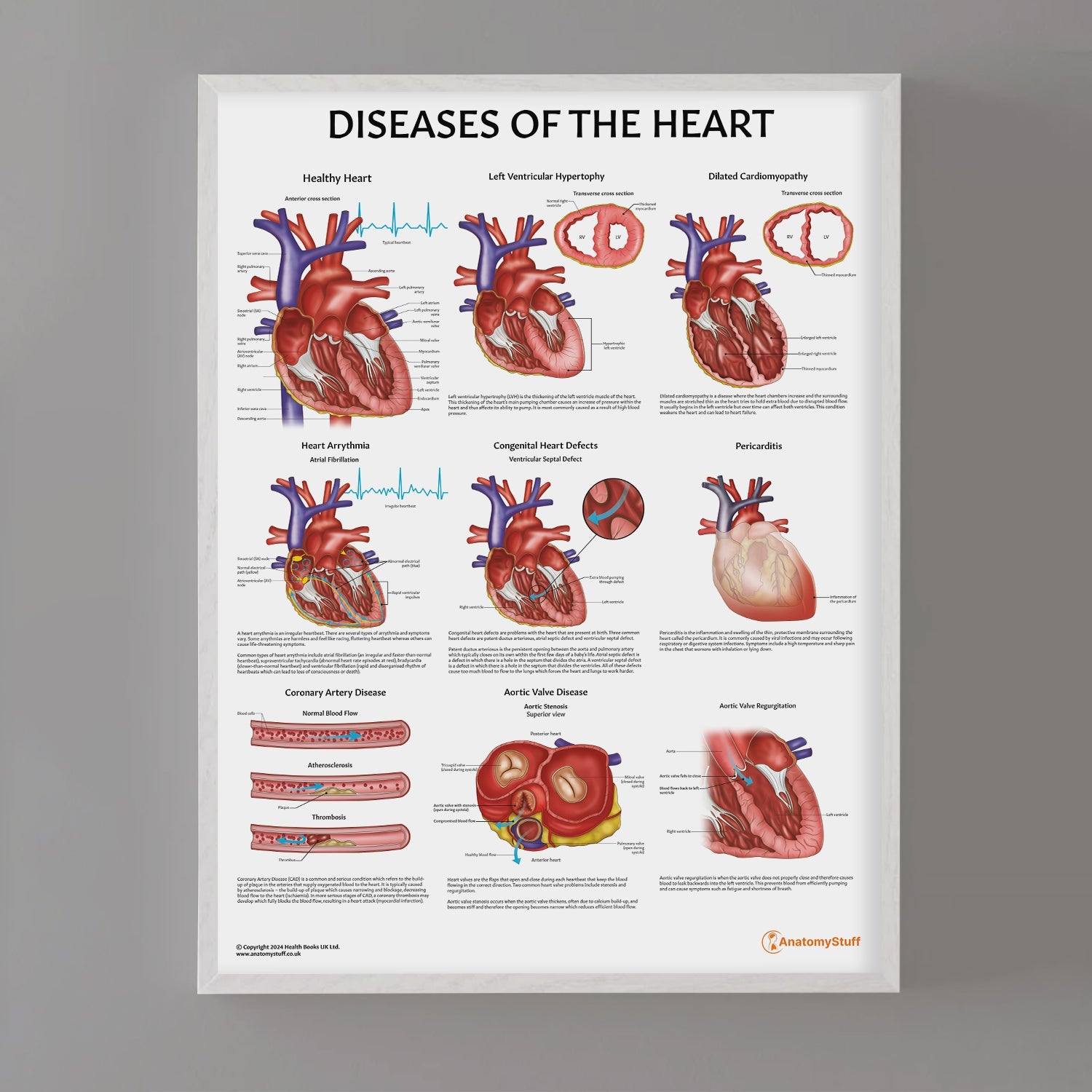Diseases of the Heart Chart / Poster - Part of Collection