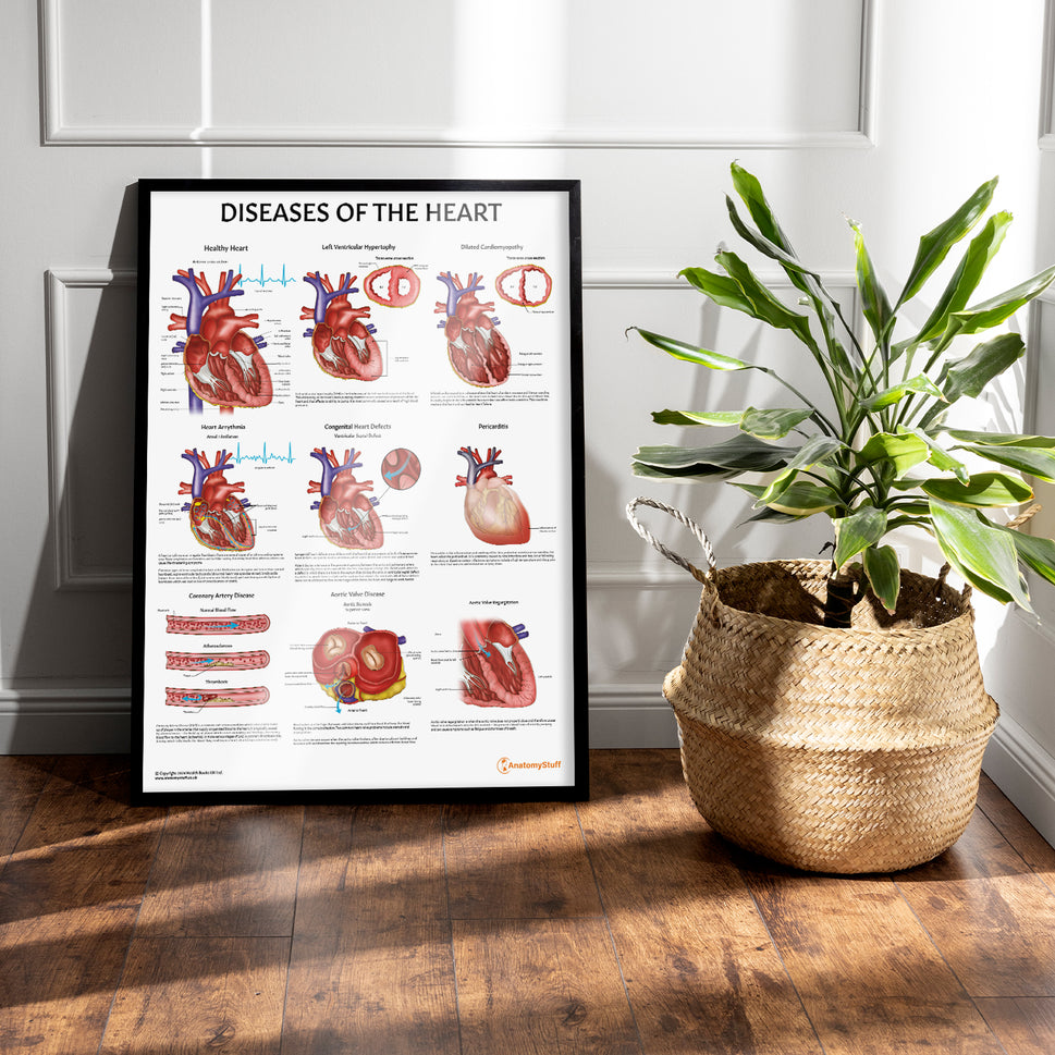 Diseases of the Heart Chart / Poster