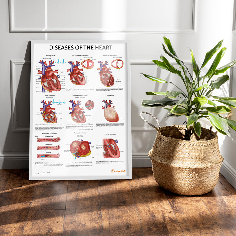 Diseases of the Heart Chart / Poster