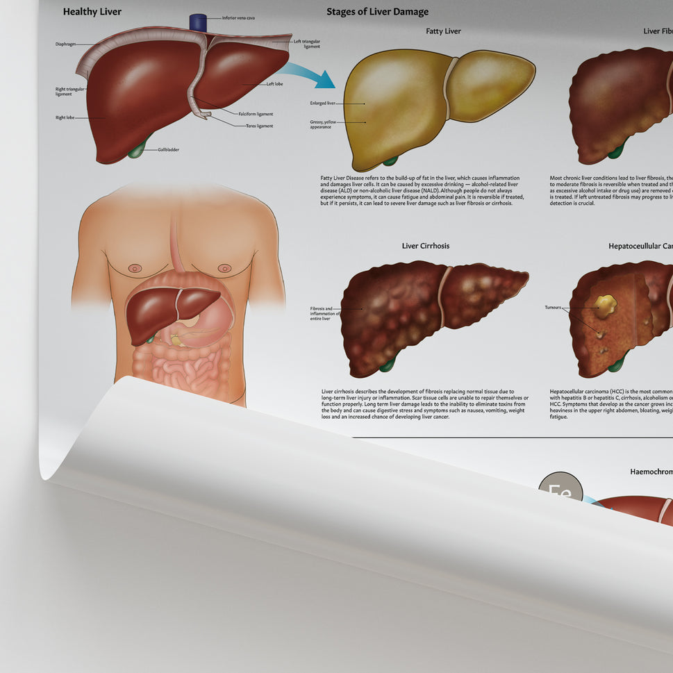Diseases of the Liver Chart / Poster