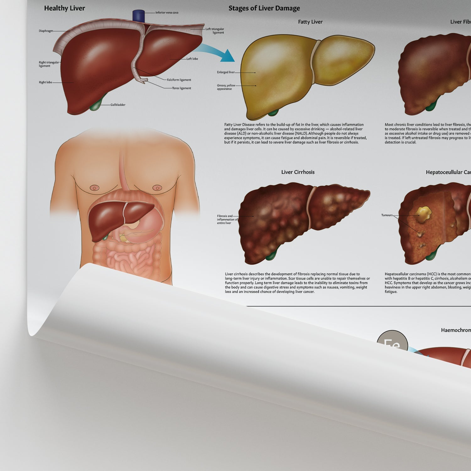 Diseases of the Liver System Chart / Poster - Part of Collection