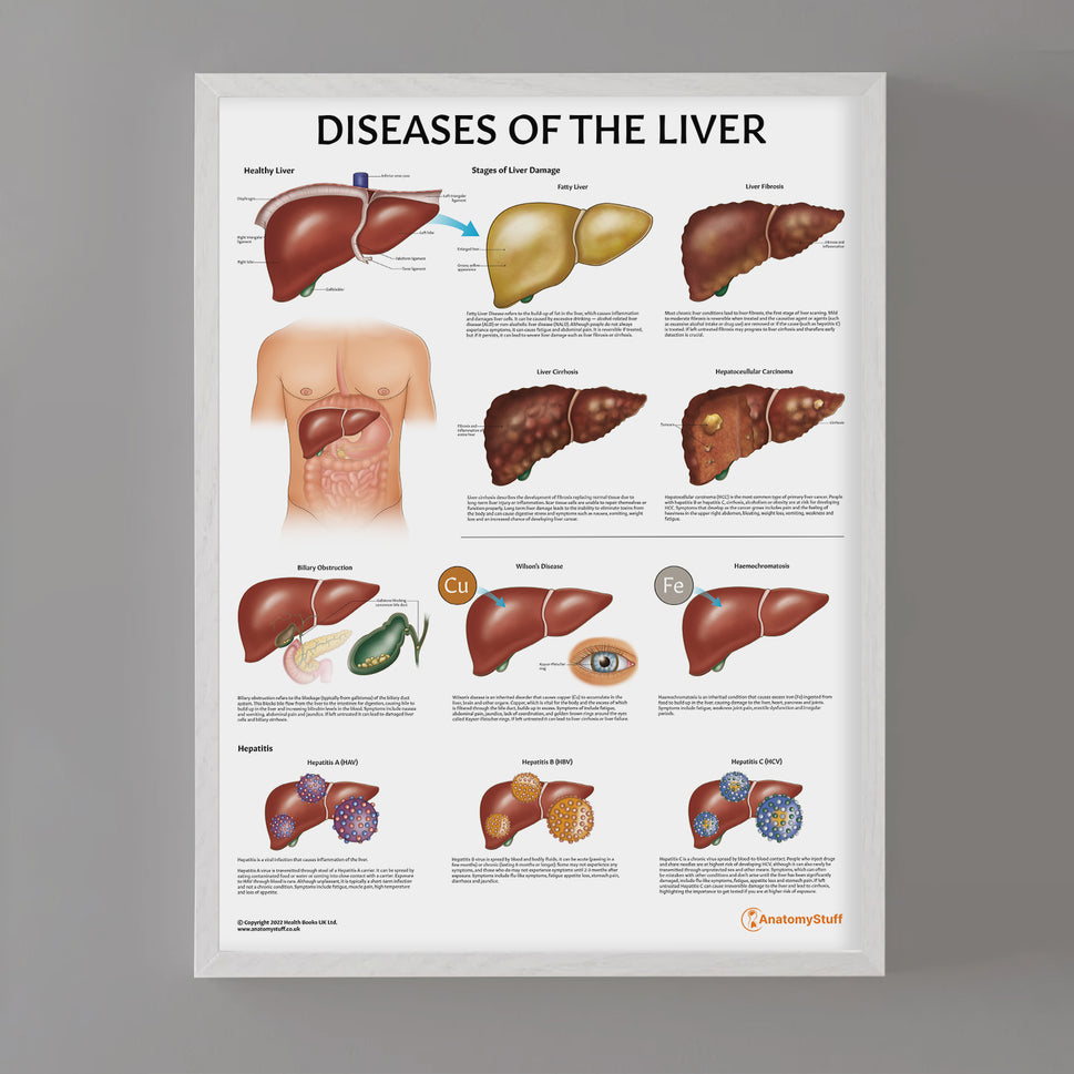 Diseases of the Liver Chart / Poster