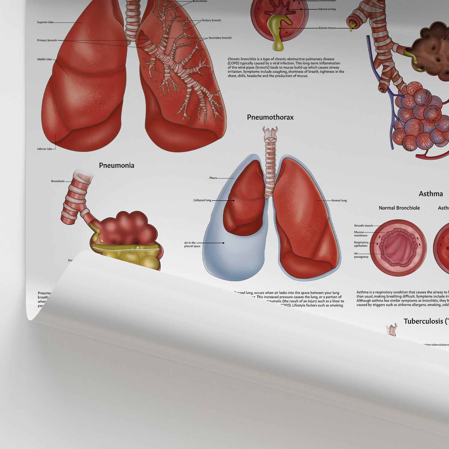 Diseases of the Lungs Chart / Poster - Part of Collection