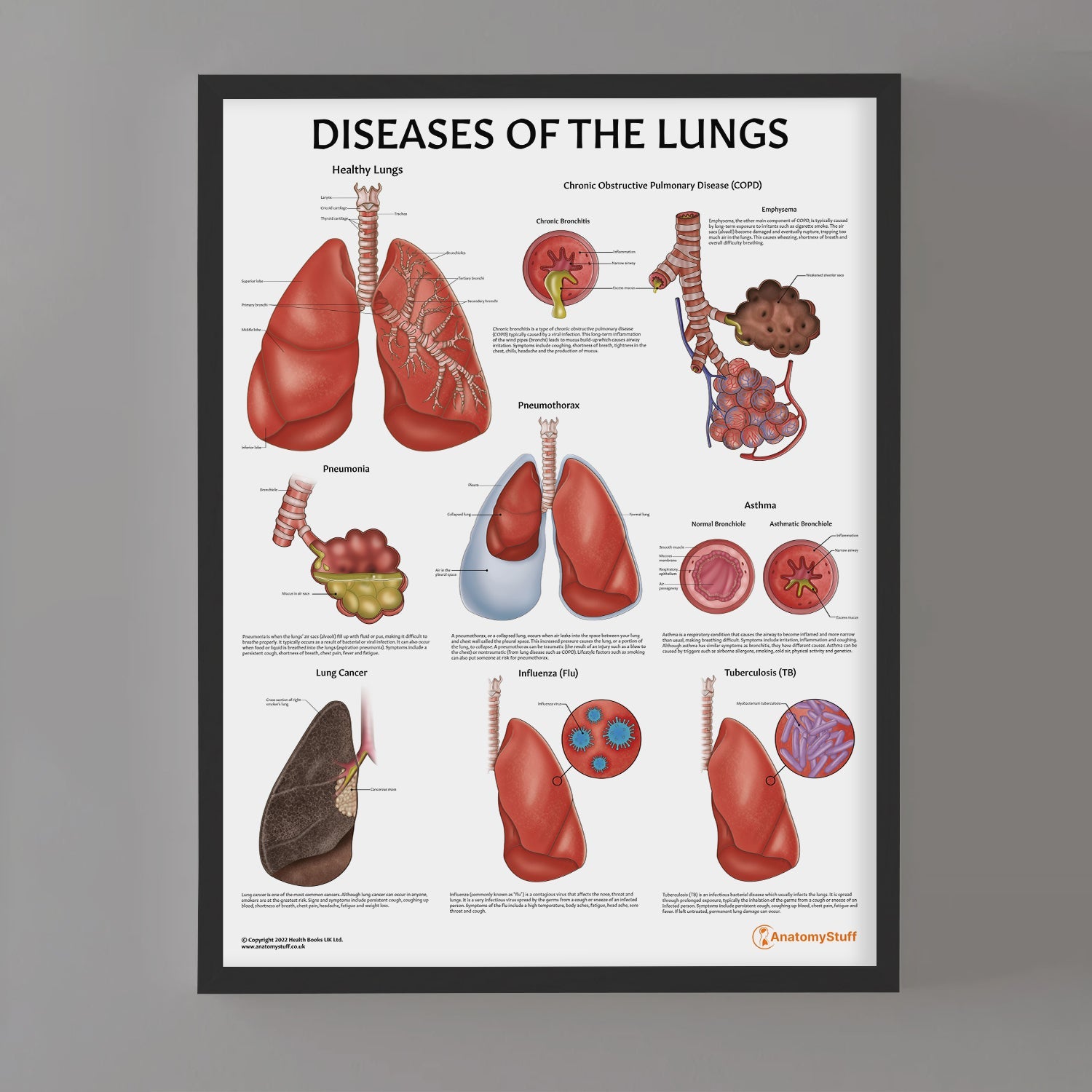 Diseases of the Lungs Chart / Poster - Part of Collection