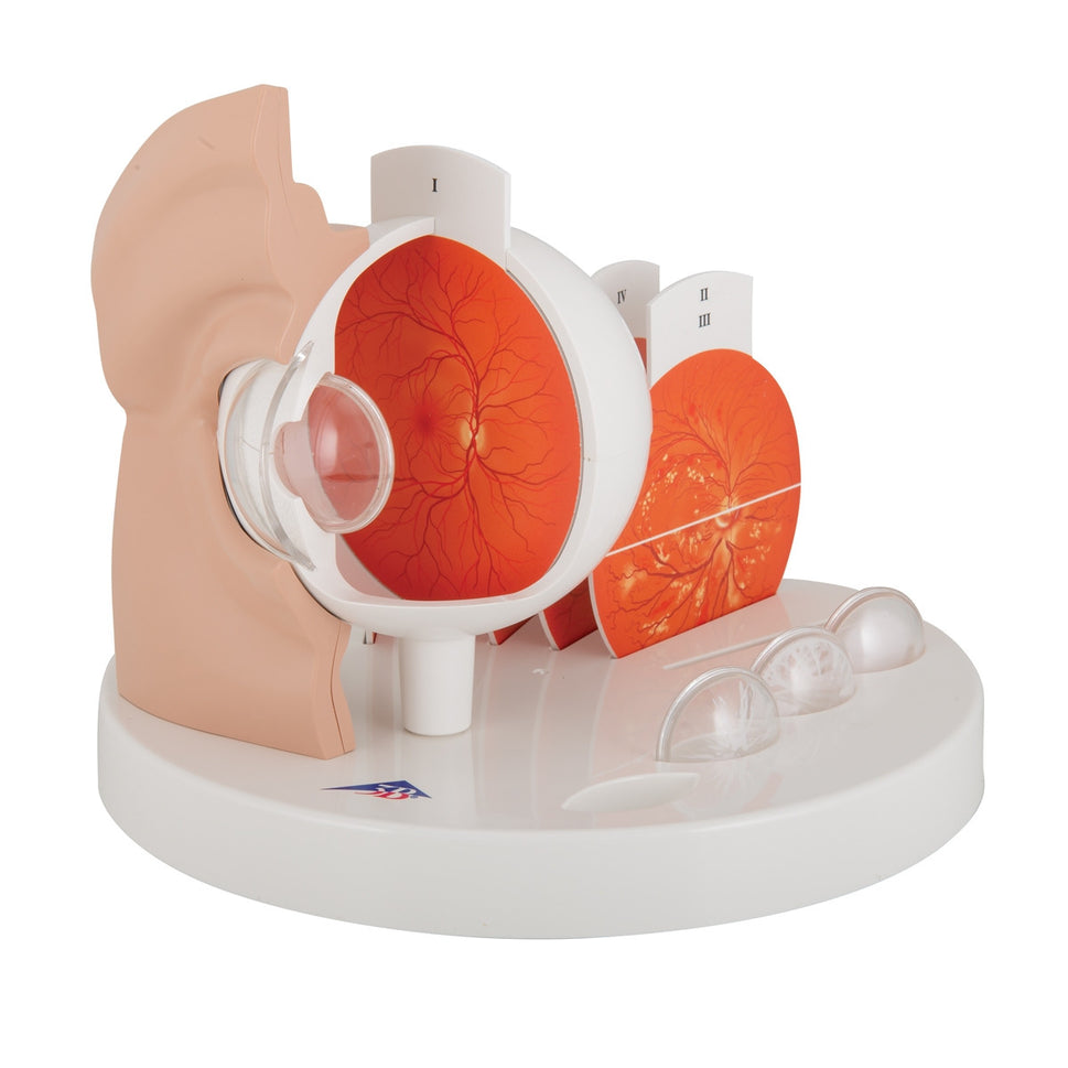 Pathological Eye Model