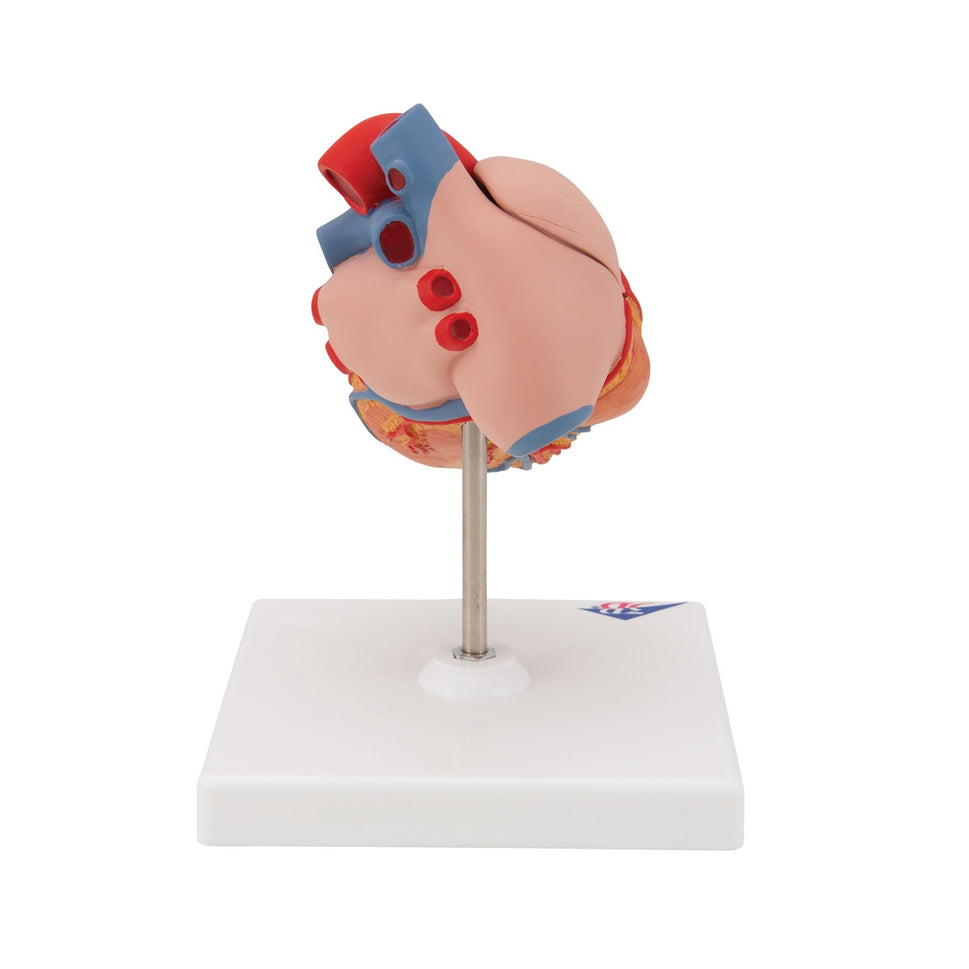 Heart Model with Left Ventricular Hypertrophy (2 part)