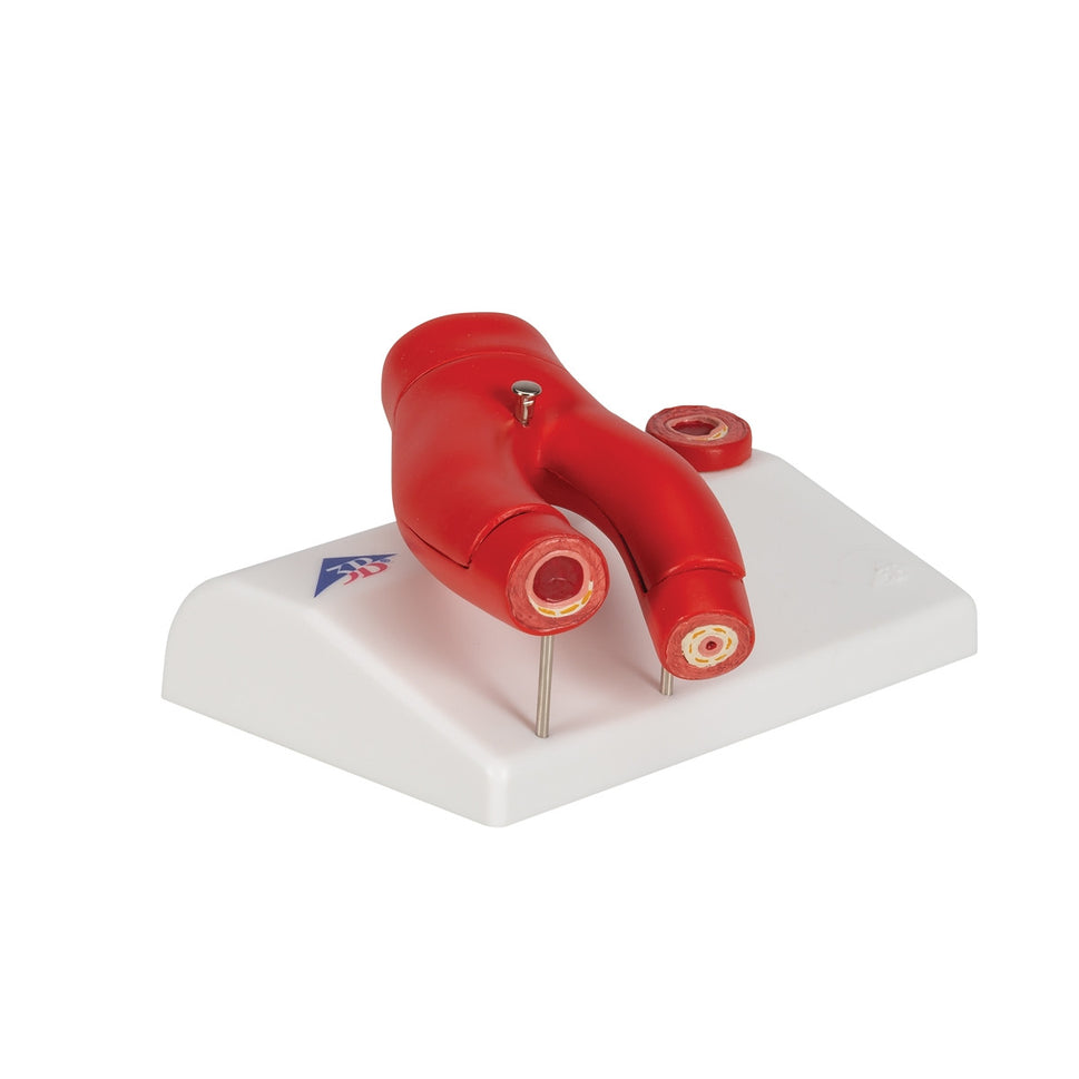 Atherosclerosis Cross Section Model (2 part)