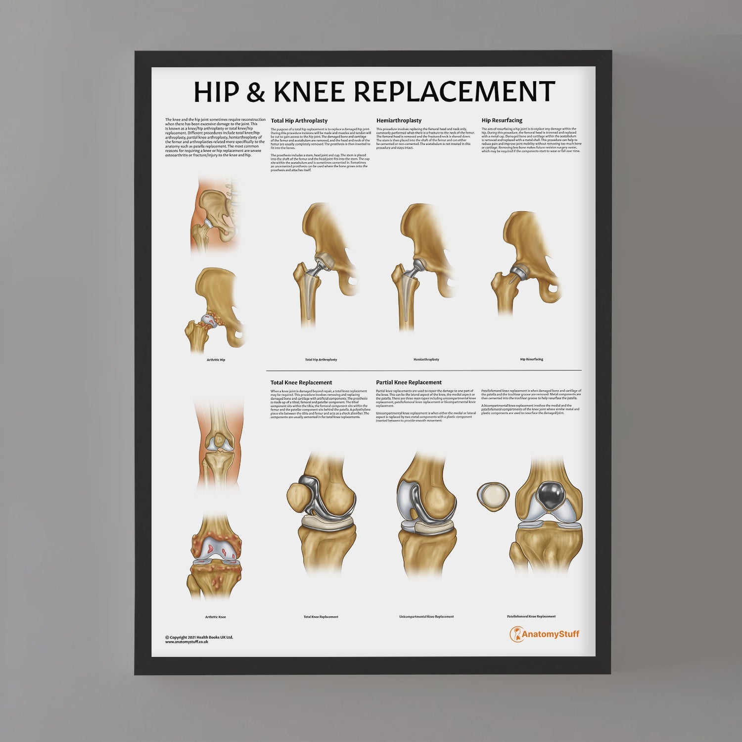 Hip & Knee Replacement Chart / Poster - Part of Collection