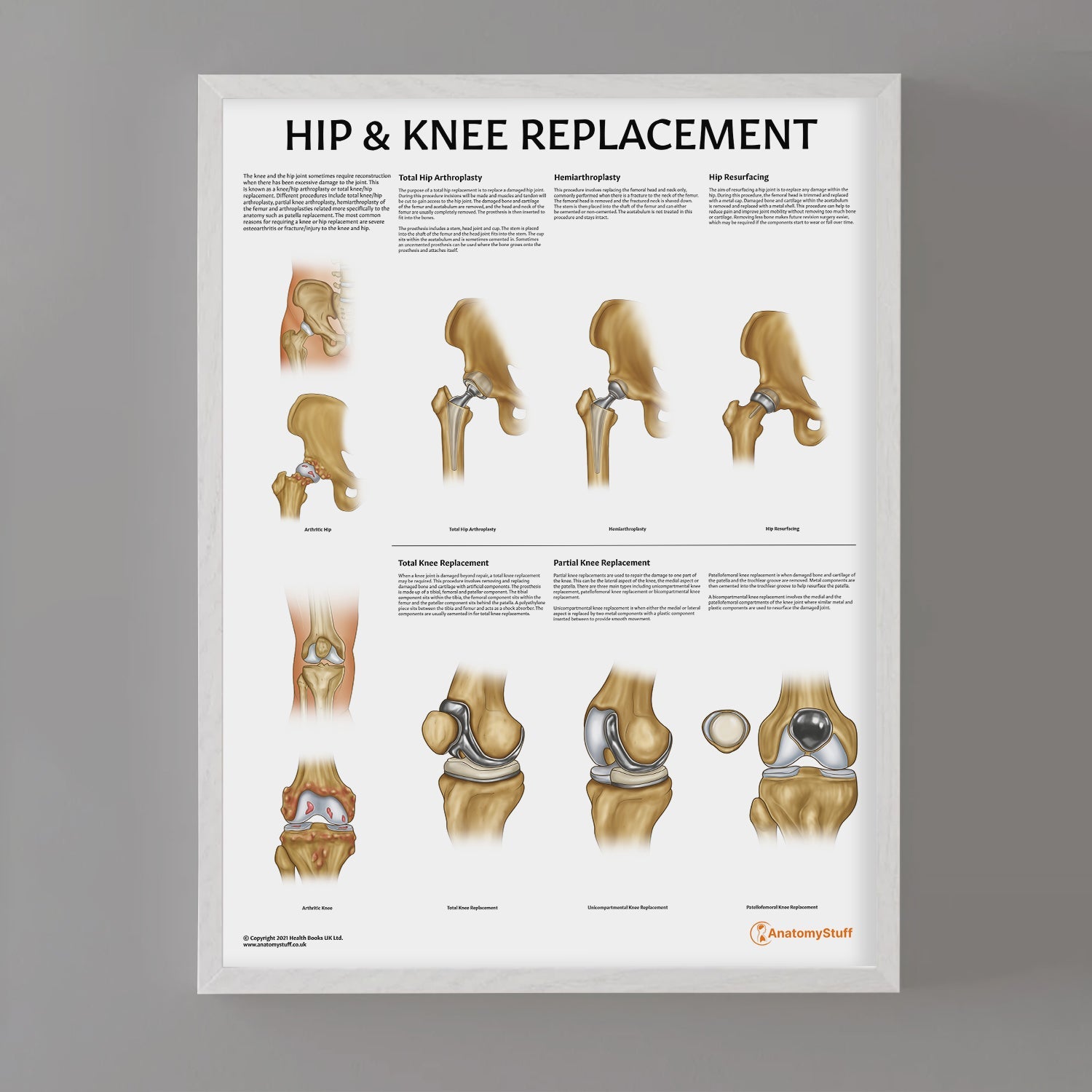 Hip & Knee Replacement Chart / Poster - Part of Collection