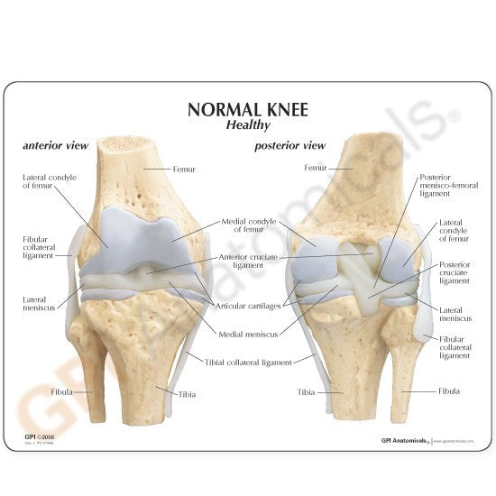 Osteoarthritis Knee Model Set (4 stages)