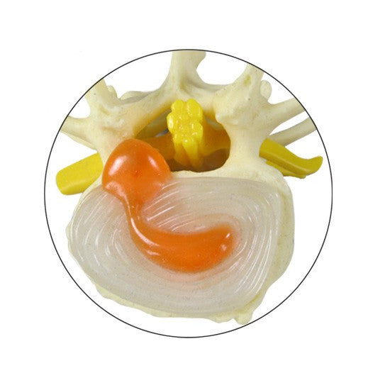 Lumbar Spine Degeneration Model Set (4 stages)