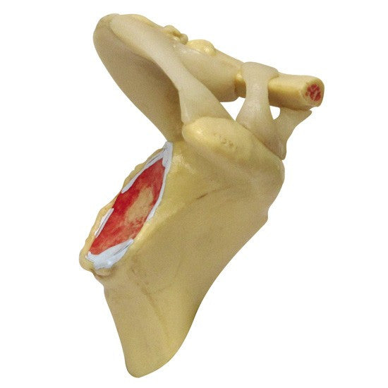 Shoulder Osteoarthritis Model Set (4 stages)