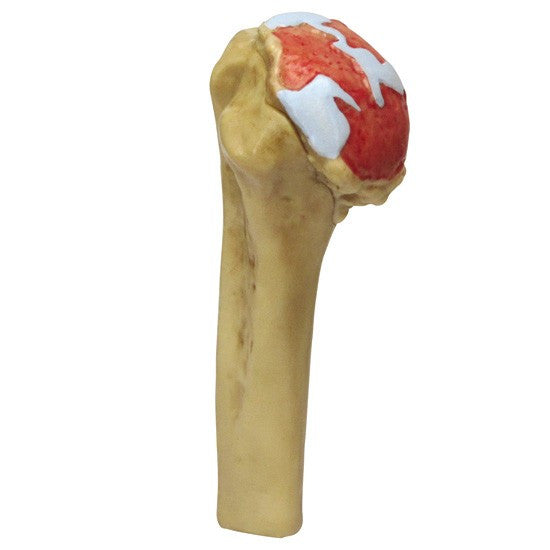 Shoulder Osteoarthritis Model Set (4 stages)
