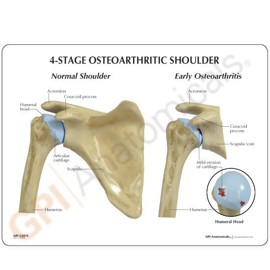 Shoulder Osteoarthritis Model Set (4 stages)