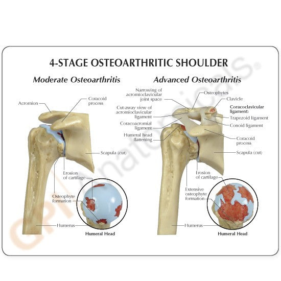 Shoulder Osteoarthritis Model Set (4 stages)