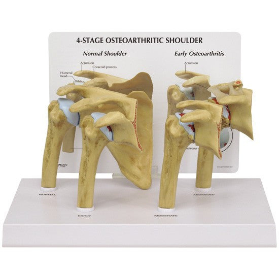 Shoulder Osteoarthritis Model Set (4 stages)